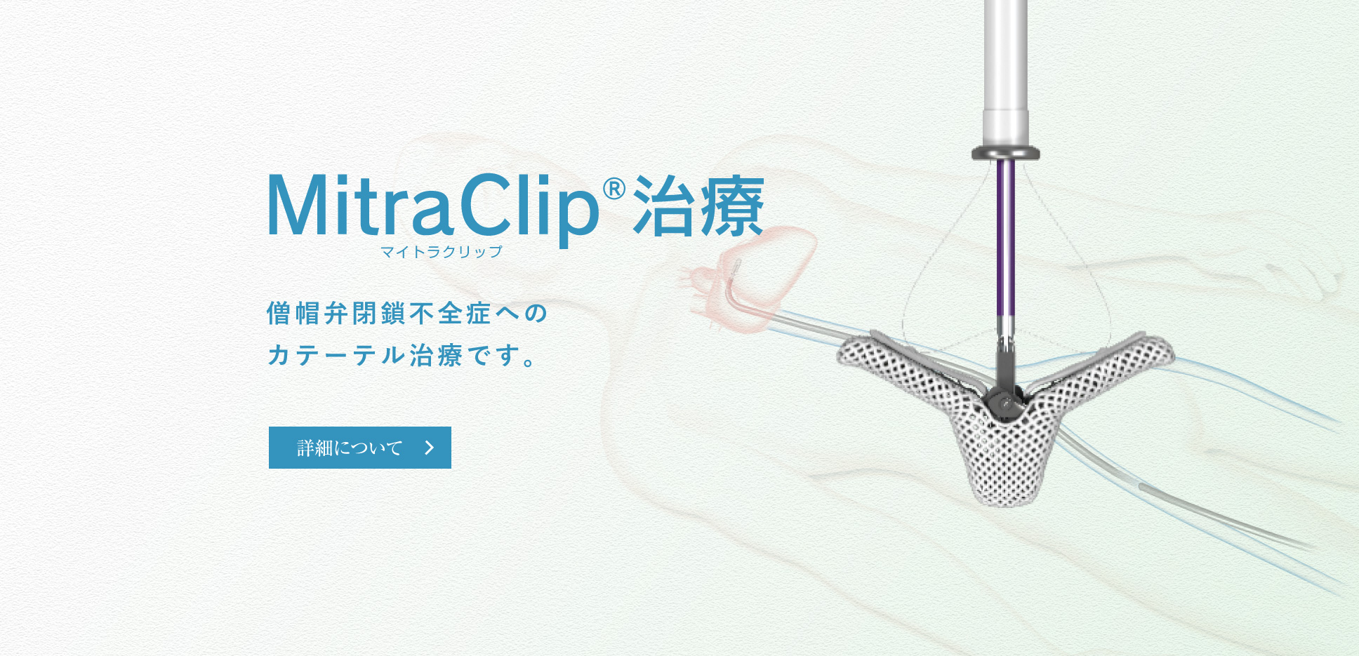MitraClip®治療　僧帽弁閉鎖不全症へのカテーテル治療です。
